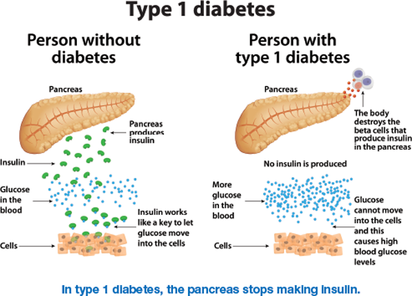 In type 1 diabetes, the pancreas stops making insulin. Overview of the pancreas (person without diabetes and person with type 1 diabetes).