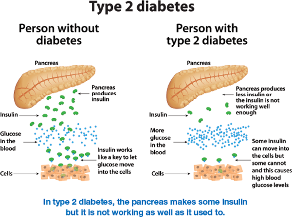In type 2 diabetes, the pancreas makes some insulin but it’s not working as well as it used to. Overview of the pancreas (person without diabetes and person with type 2 diabetes).